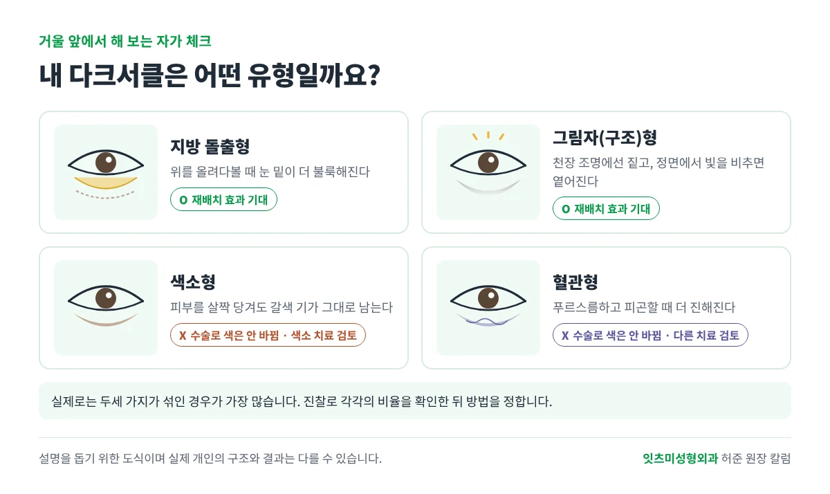 다크서클 유형 자가 체크 그림. 지방 돌출형과 그림자(구조)형은 재배치 효과를 기대할 수 있고, 색소형과 혈관형은 수술로 색이 바뀌지 않는다.