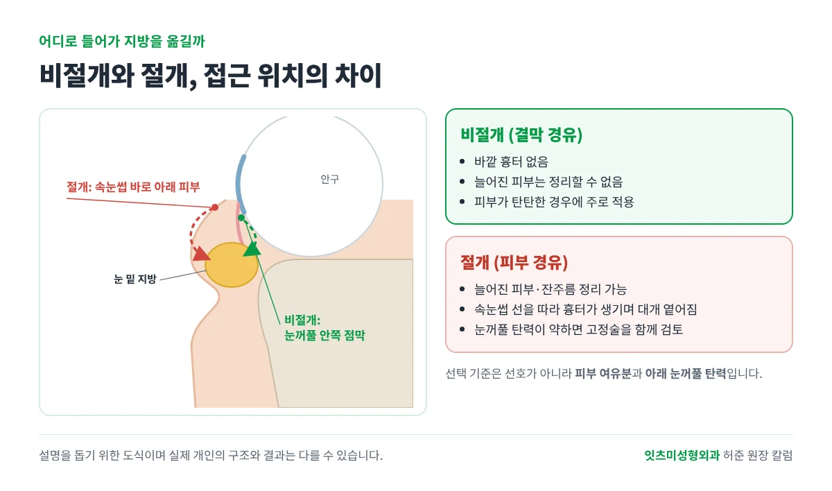 아래 눈꺼풀 단면도. 비절개는 눈꺼풀 안쪽 점막으로, 절개는 속눈썹 바로 아래 피부로 들어가 눈 밑 지방에 접근한다.